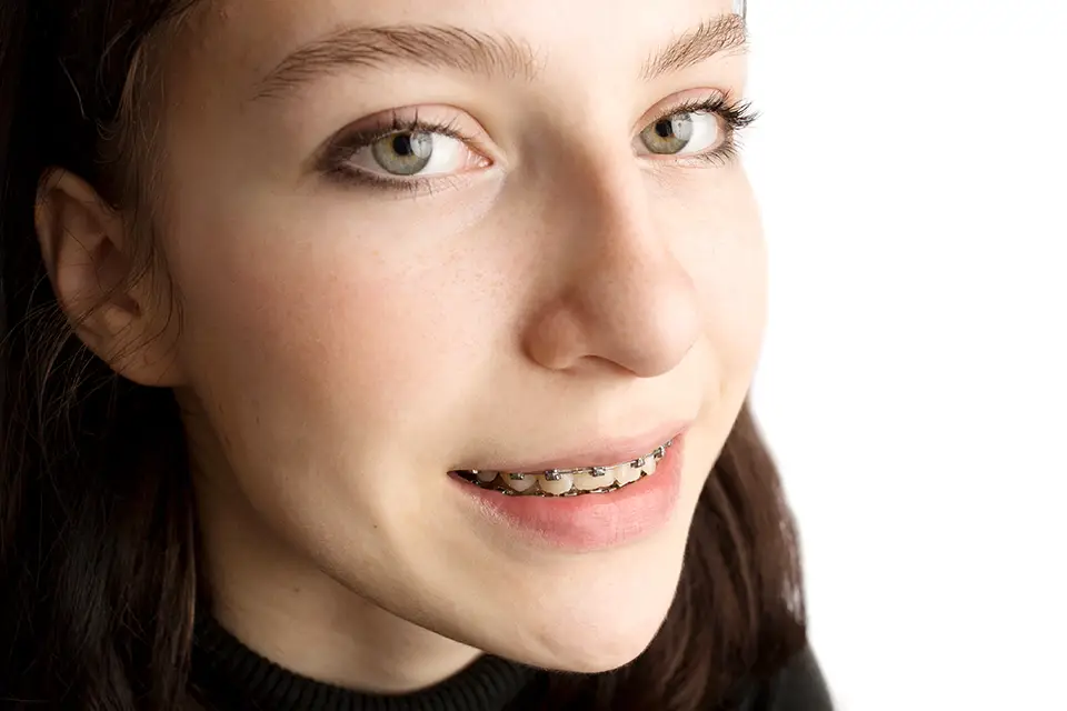 Cosmetic Braces for Teens: Stylish and Effective Options in Alliston