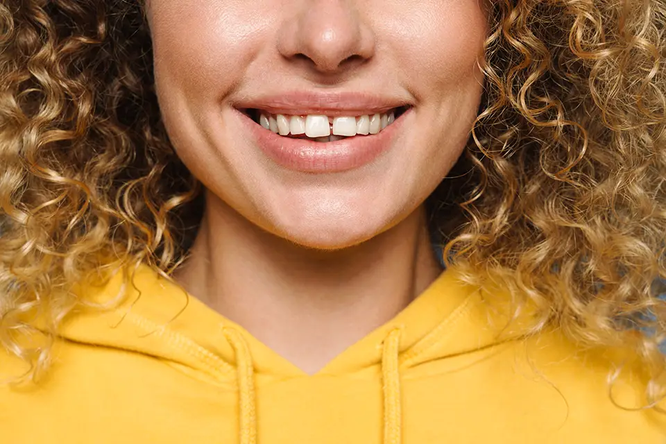 Tooth Reshaping Before and After: See the Stunning Results