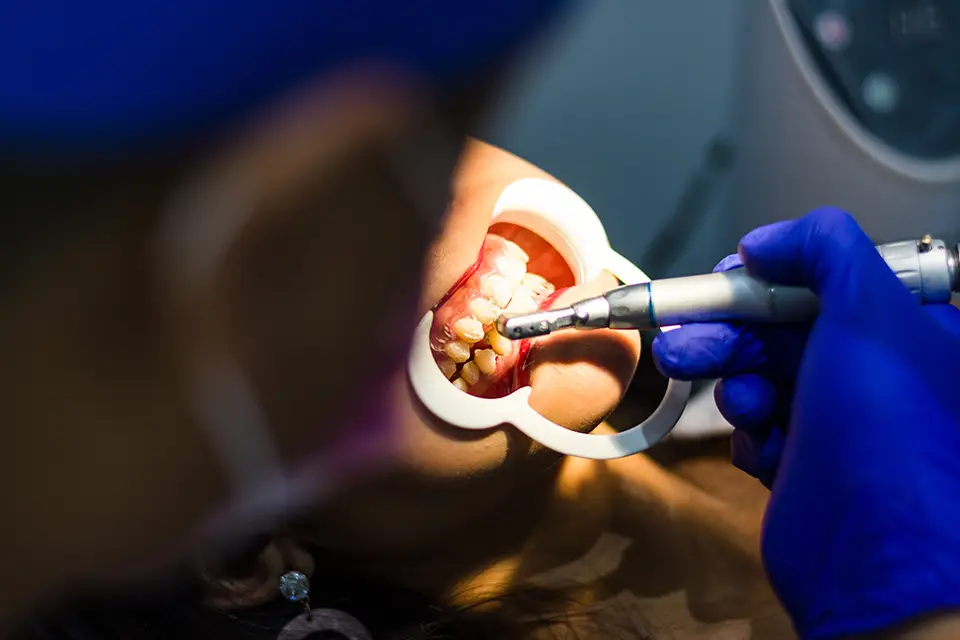 Replace Amalgam Fillings with Composites in Alliston