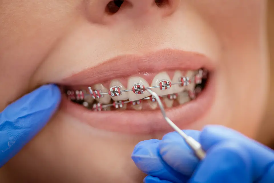 Braces and Invisalign in Alliston: How Tooth Movement Works