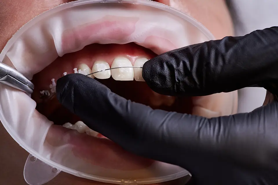 Braces and Invisalign in Alliston: Sports, Work, Travel: Real-World Logistics That Matter