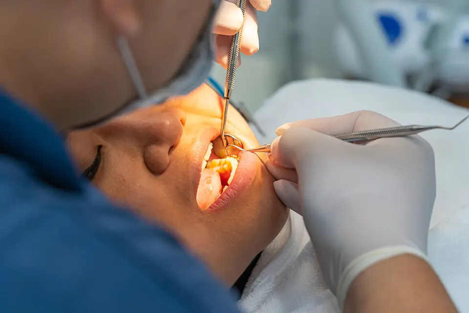 Root Canal Cost in Ontario: What Affects Your Fee in Alliston?