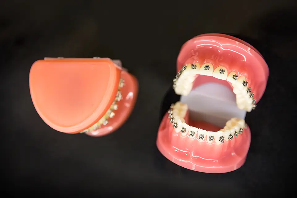 Braces and Invisalign in Alliston | Straighten Your Smile