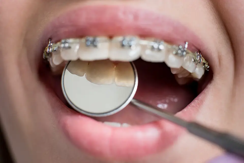 Affordable Braces in Alliston: Practical Ways to Lower the Total