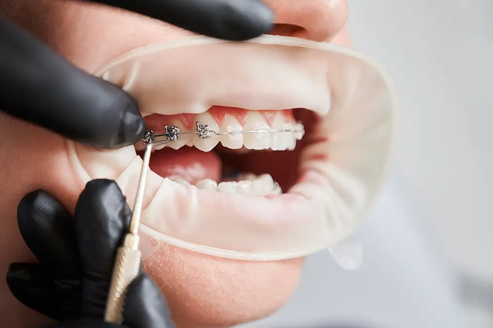 Adult Orthodontist in Alliston – Braces & Invisalign for Grown-Ups