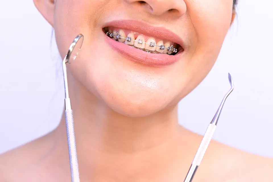 Affordable Braces in Alliston – Straighten Your Smile on a Budget