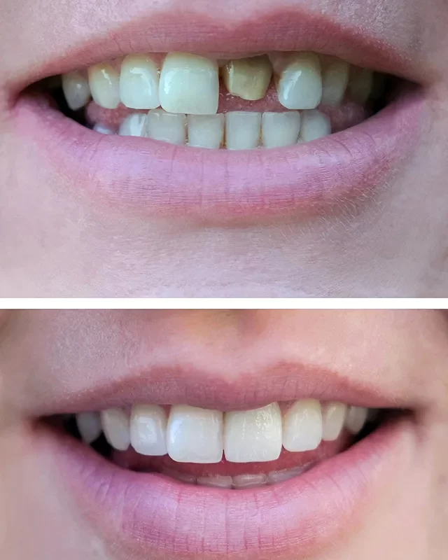 Dental Crowns - kingdentalcentre