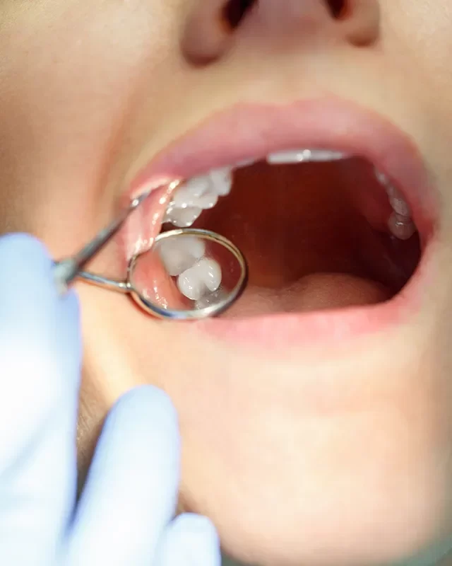 Dental Fillings - kingdentalcentre