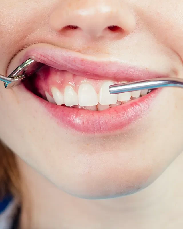 Gum Disease Treatment - kingdentalcentre