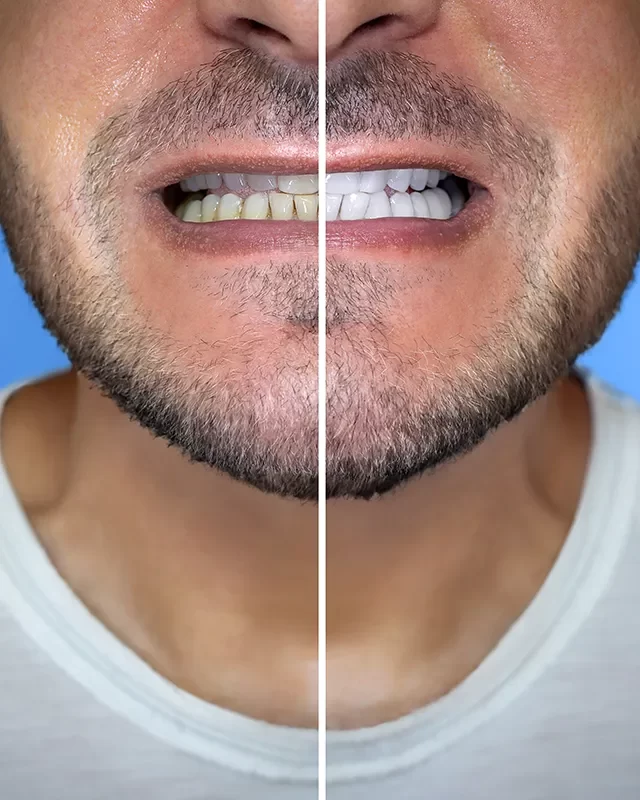 Teeth Whitening - kingdentalcentre