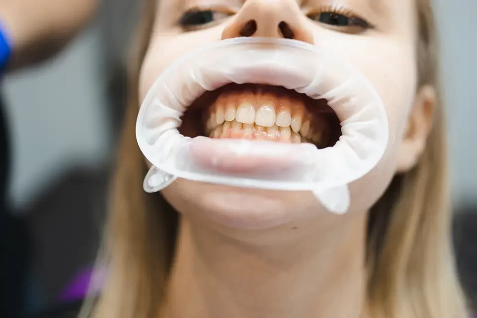 Teeth Whitening vs Veneers: A Direct Comparison