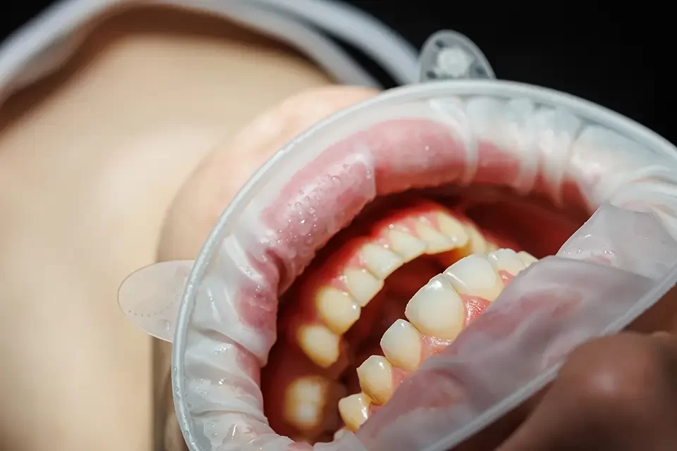 Full Mouth Dental Implants Alliston: Managing Risk and Protecting Your Result