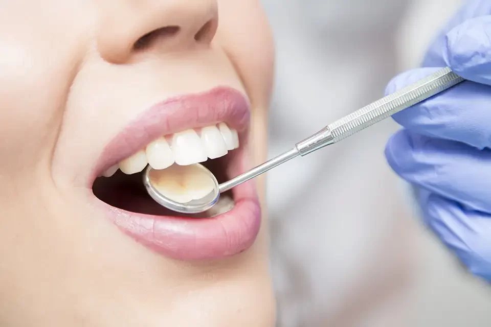 Composite Dental Fillings Alliston: What Determines Durability?