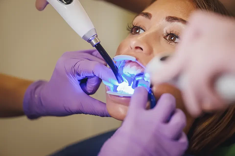 How Professional Teeth Whitening in Alliston Works: Step by Step