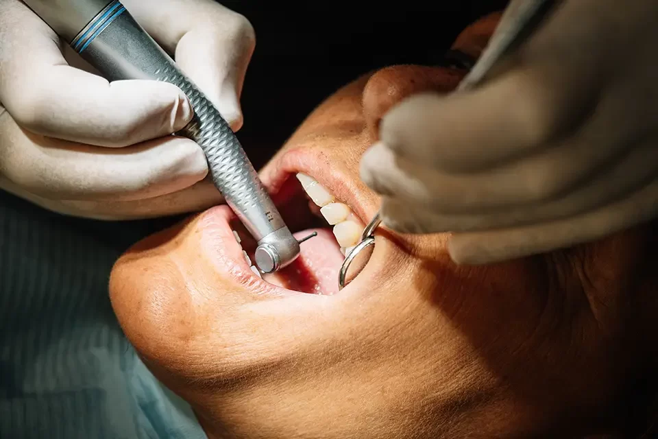 Tooth Filling Services Alliston: Step-By-Step