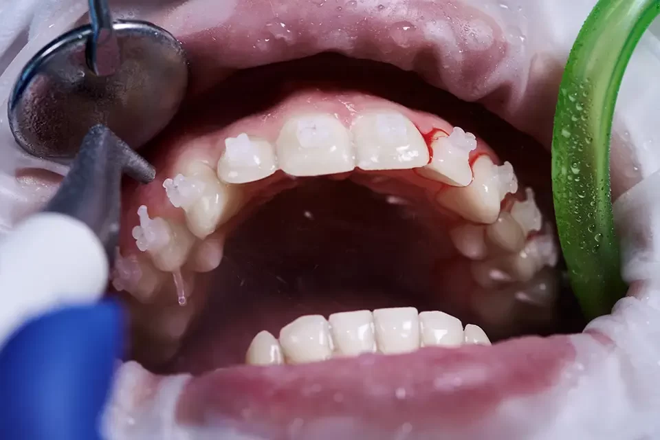 The Stunning Impact of Tooth Reshaping Before and After