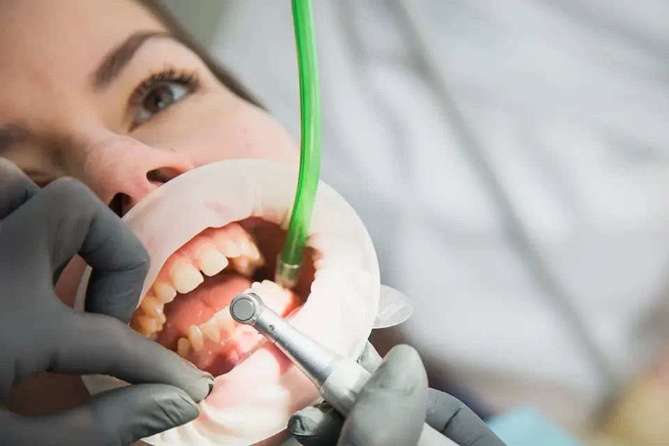 Aftercare: Amalgam Fillings Replacement Alliston