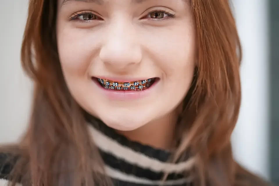 The Benefits of Choosing Cosmetic Braces for Teens
