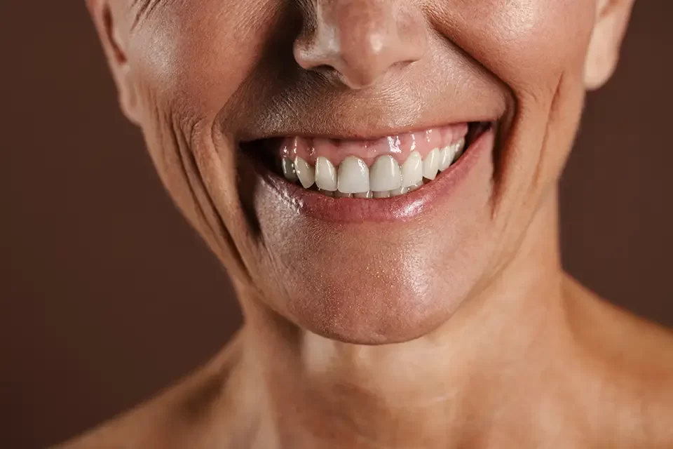Full Mouth Dental Implants Alliston: Why People Choose Them