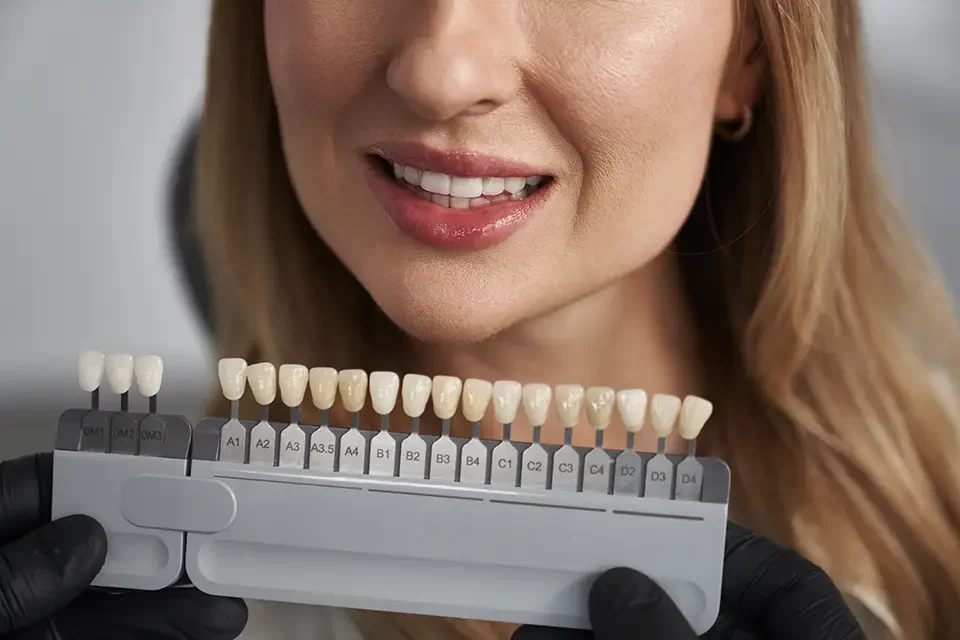 Teeth Whitening vs Veneers